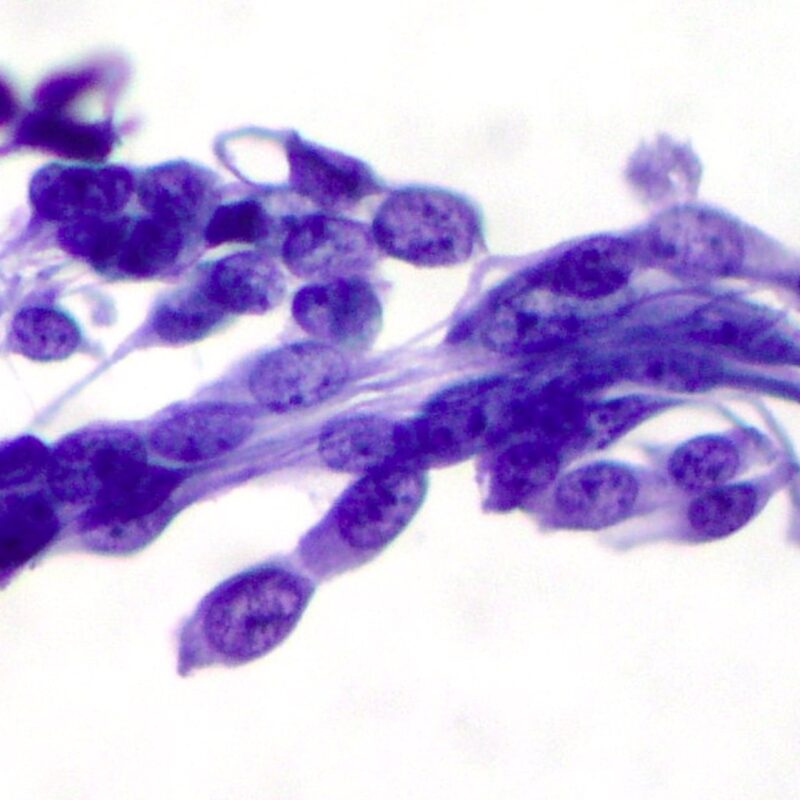 Κυτταρολογική εξέταση ούρων κάτω από το μικροσκόπιο